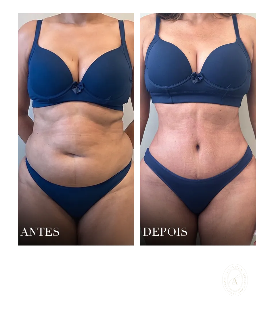 abdominioplastia