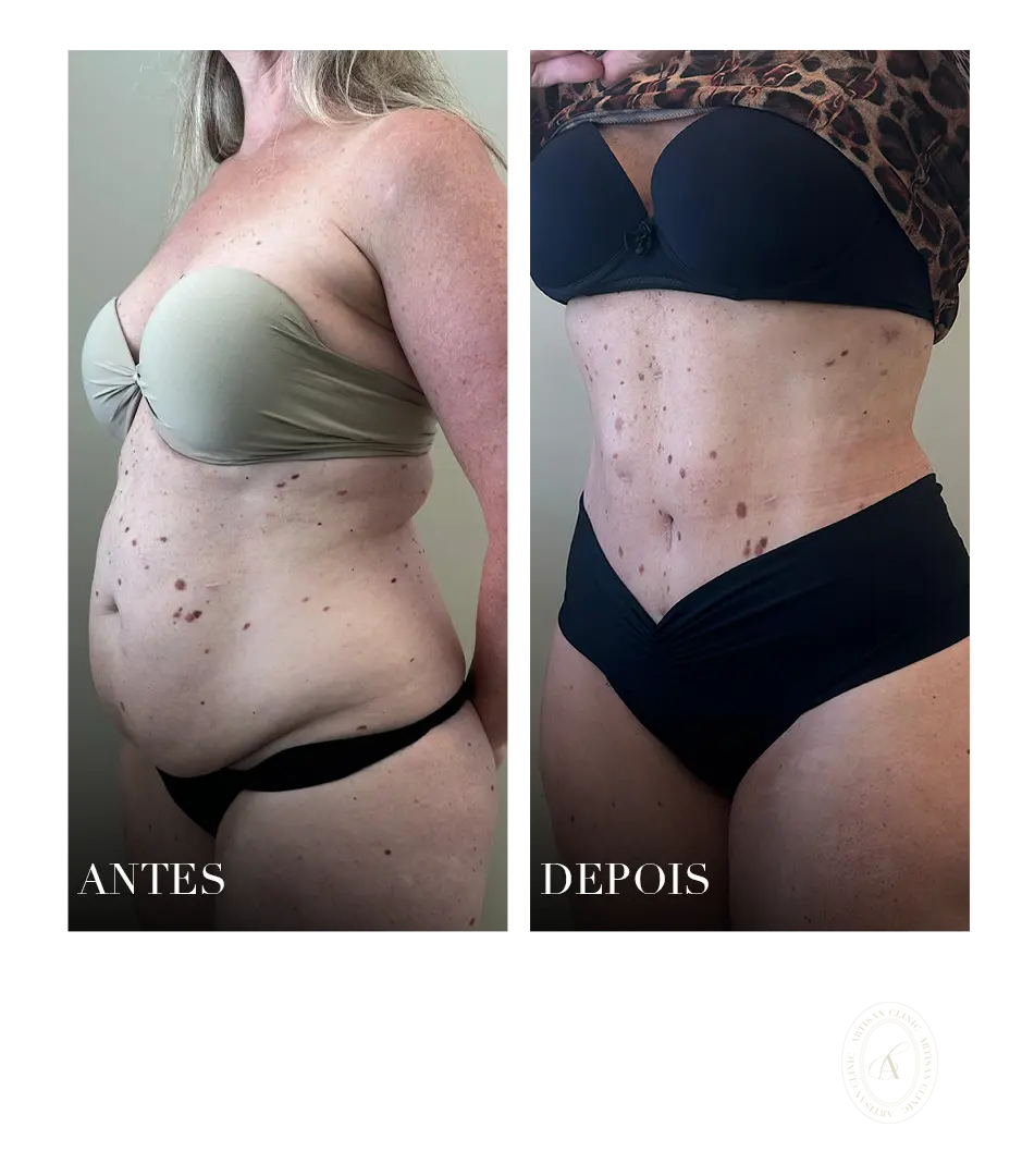 abdominoplastia e lipoaspiraçao