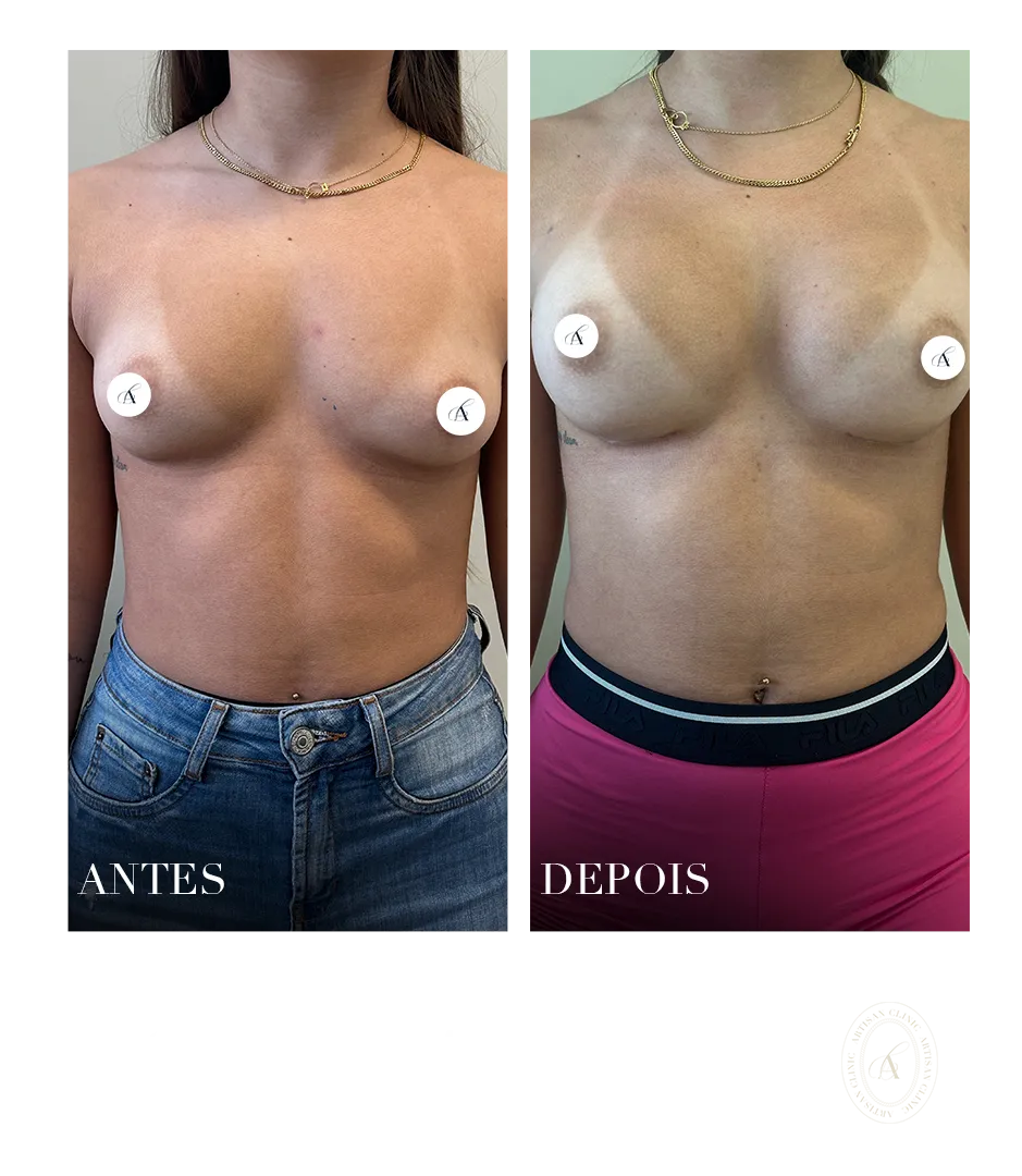 prótese de mamnapng