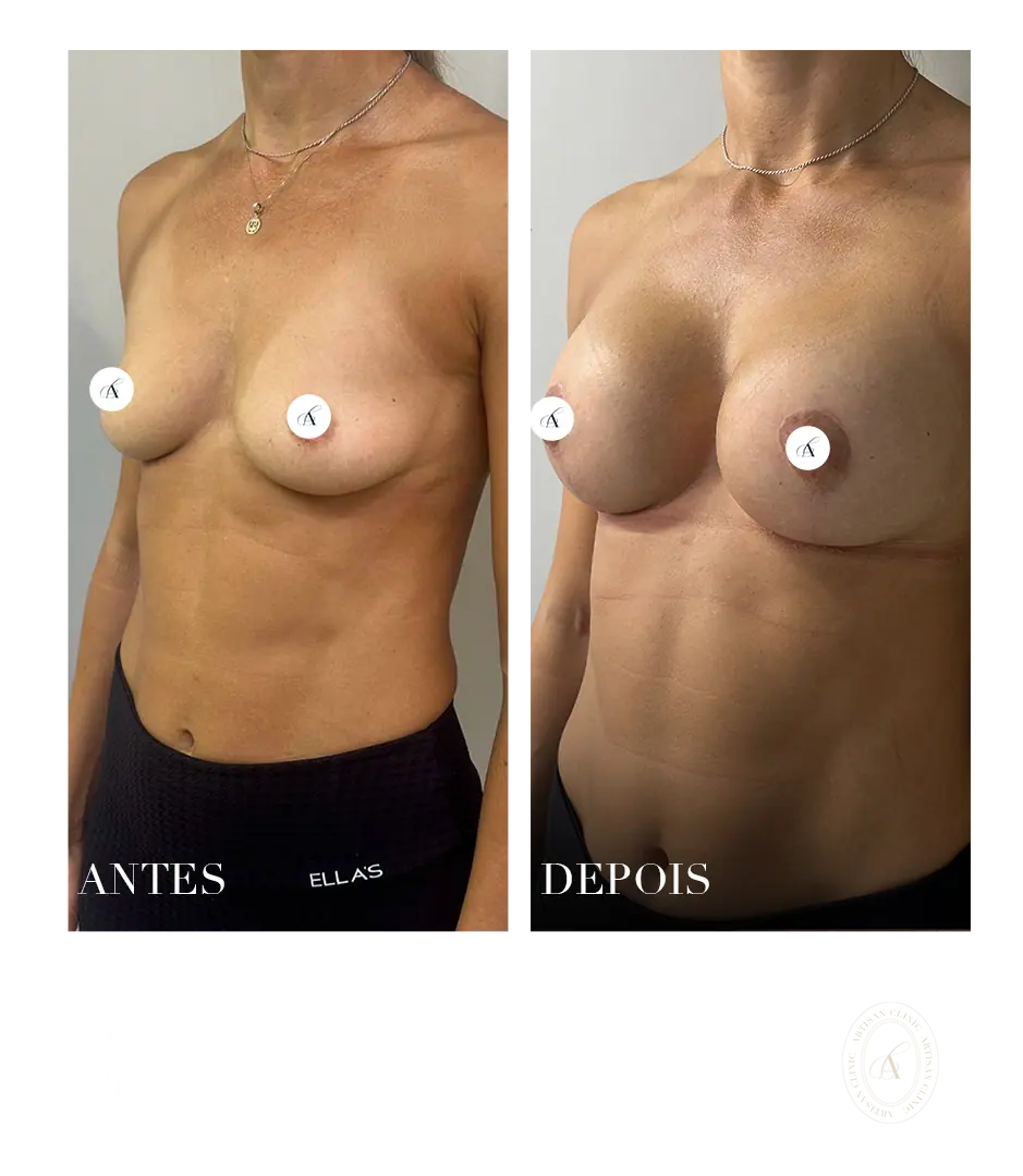 masto com protese